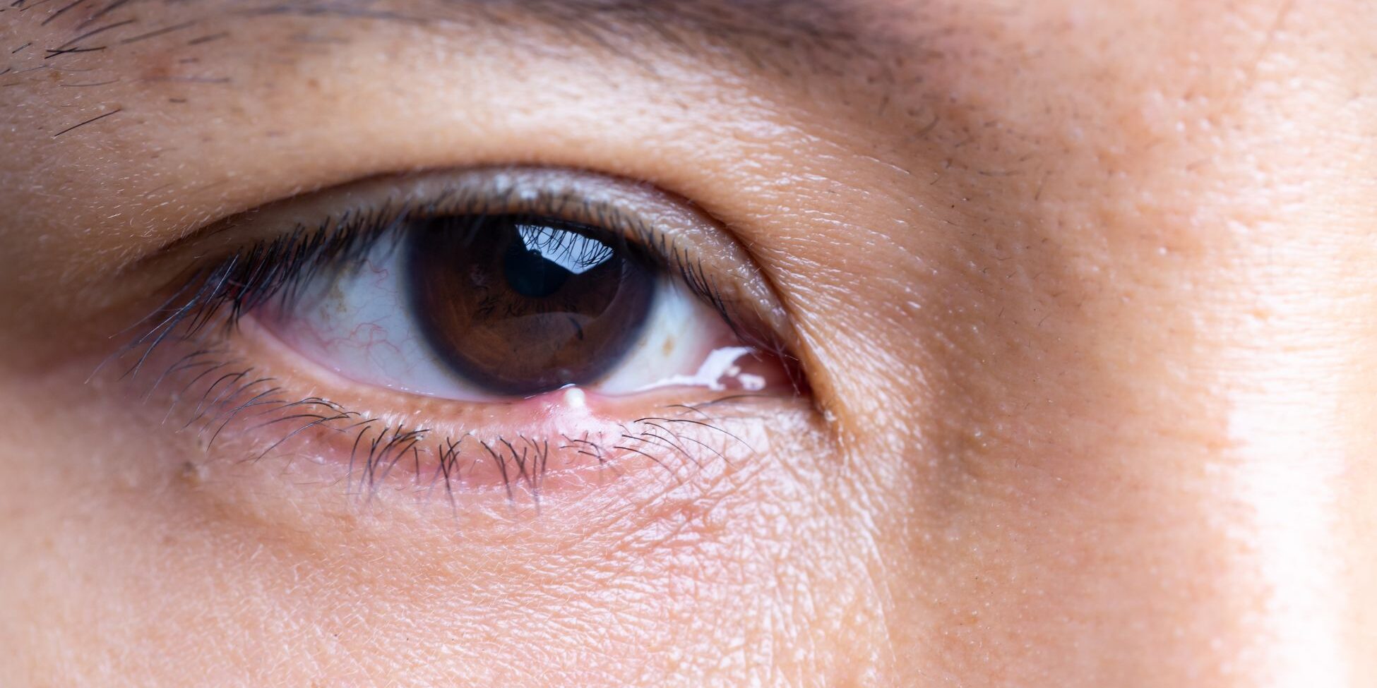La blefaritis es una inflamación crónica del borde palpebral que afecta a una proporción significativa de la población adulta. La blefaritis es una inflamación crónica del borde palpebral que afecta a una proporción significativa de la población adulta.