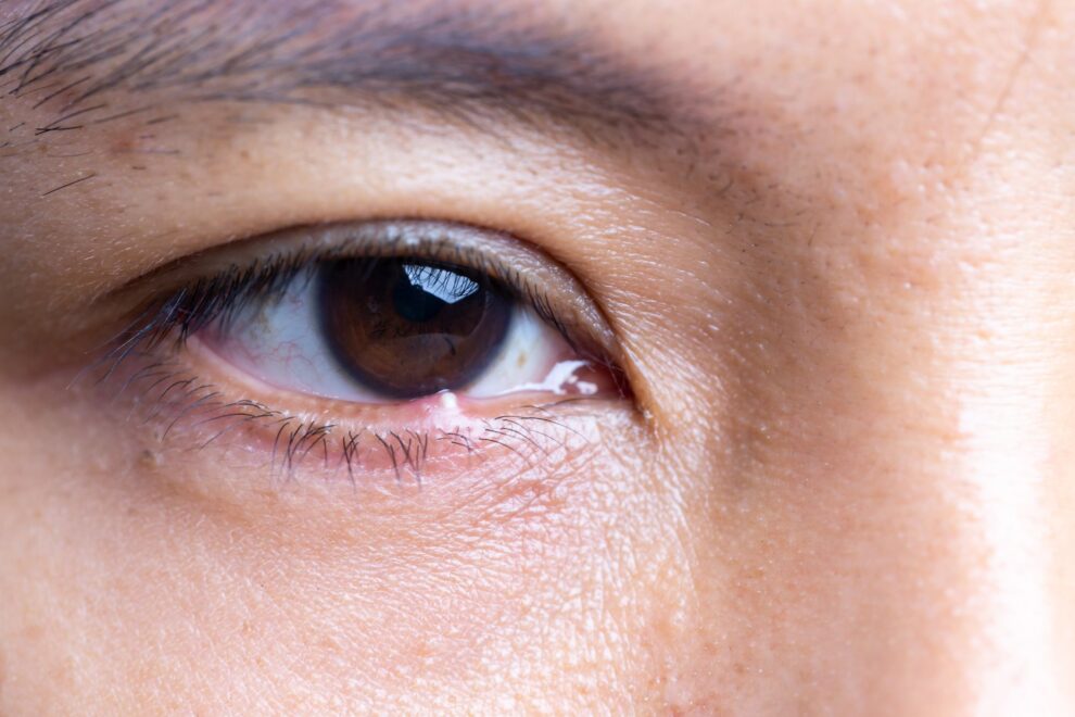 La blefaritis es una inflamación crónica del borde palpebral que afecta a una proporción significativa de la población adulta. La blefaritis es una inflamación crónica del borde palpebral que afecta a una proporción significativa de la población adulta.
